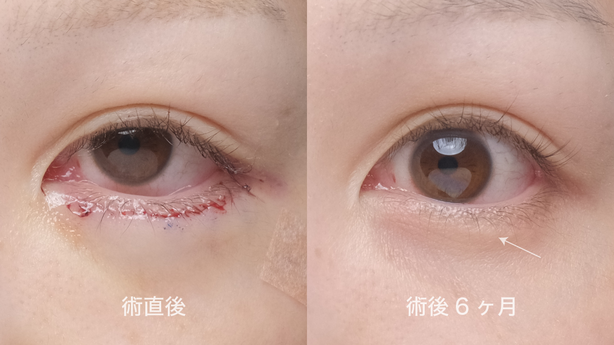 タレ目形成の傷跡