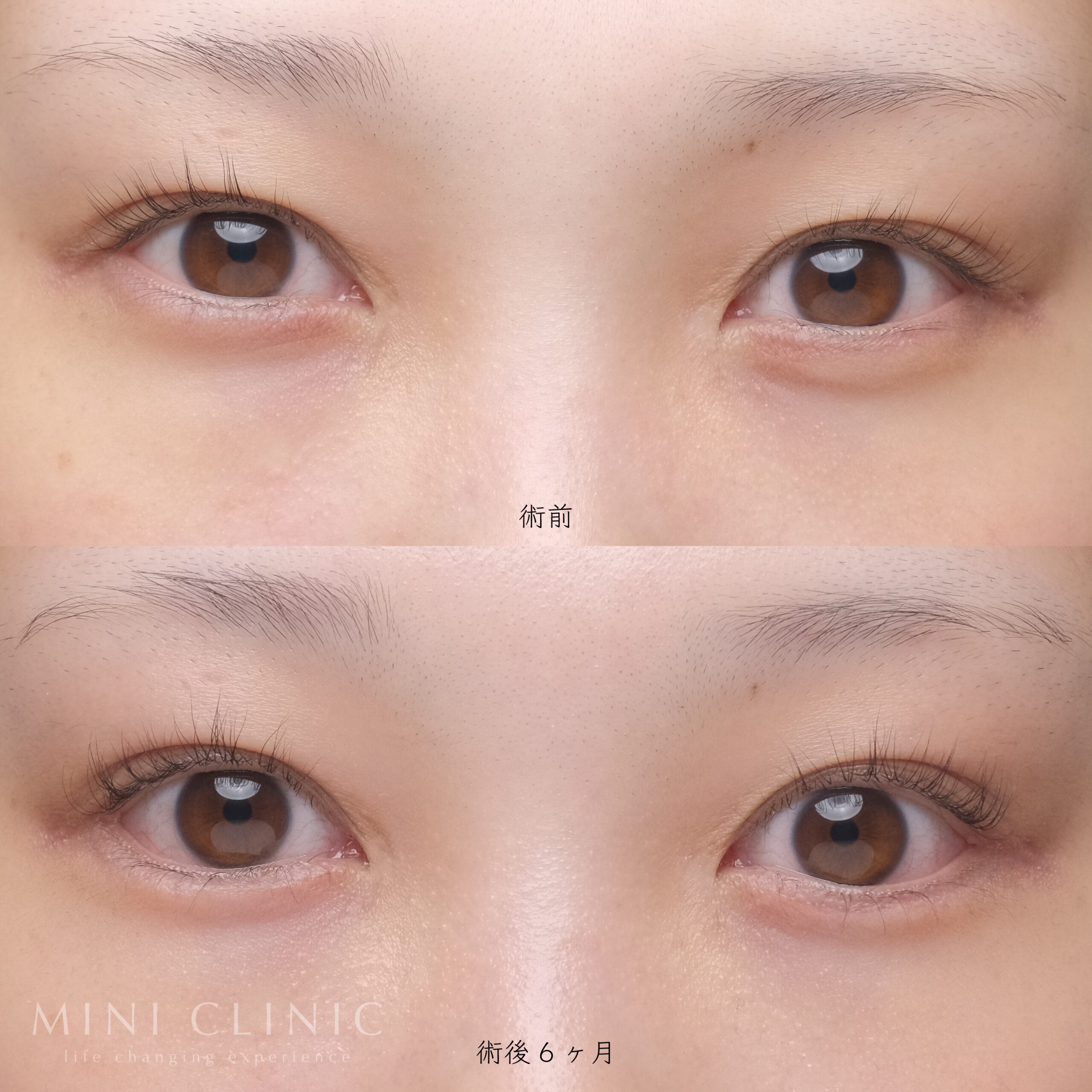 タレ目形成の症例01