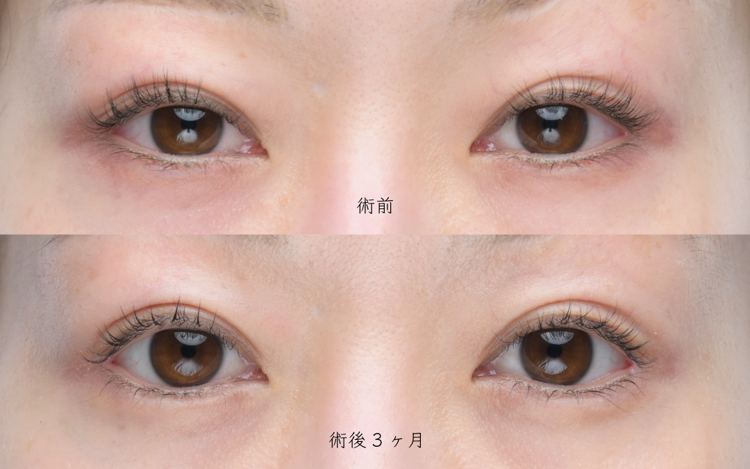 タレ目形成(グラマラスライン形成)のビフォーアフター