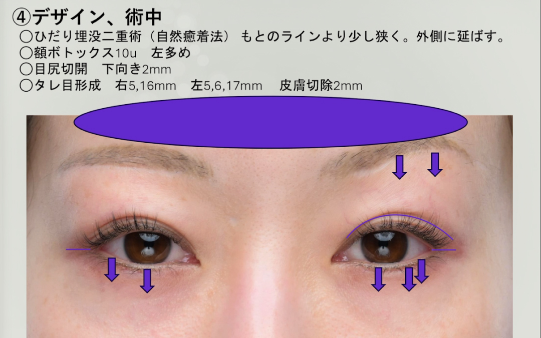 タレ目形成の手術デザインとプラン