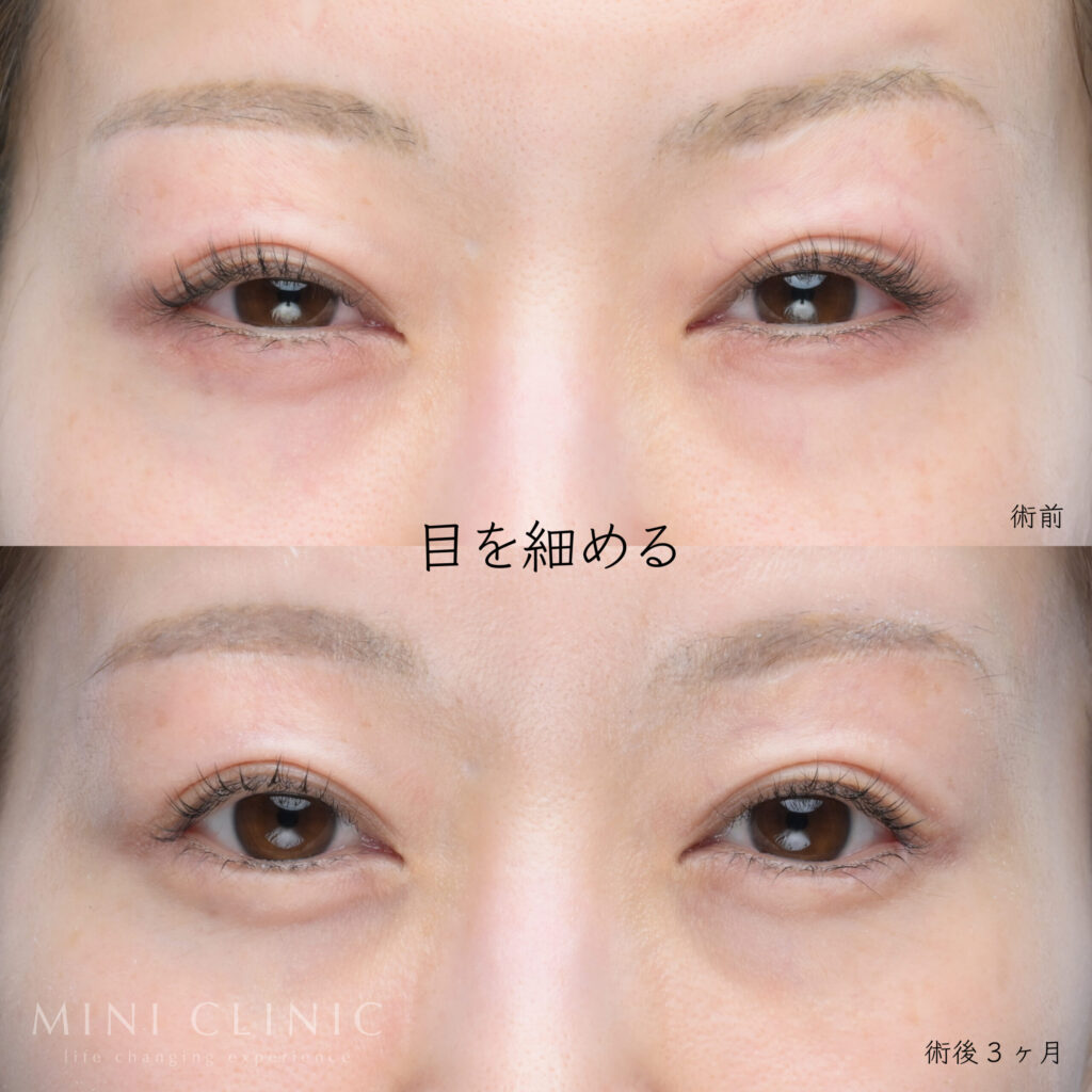 タレ目形成術後の目を細めたり笑った時の表情の写真