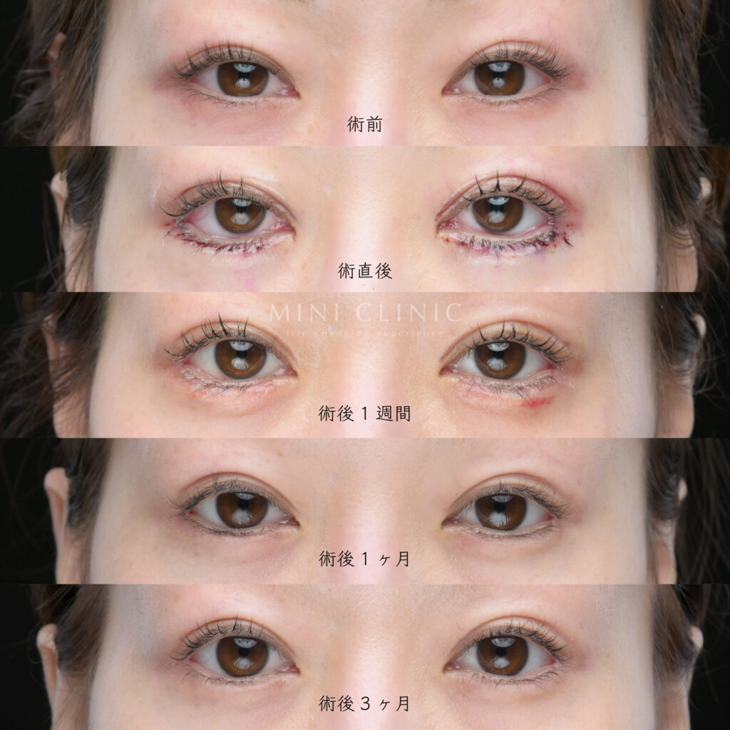タレ目形成のダウンタイム開眼