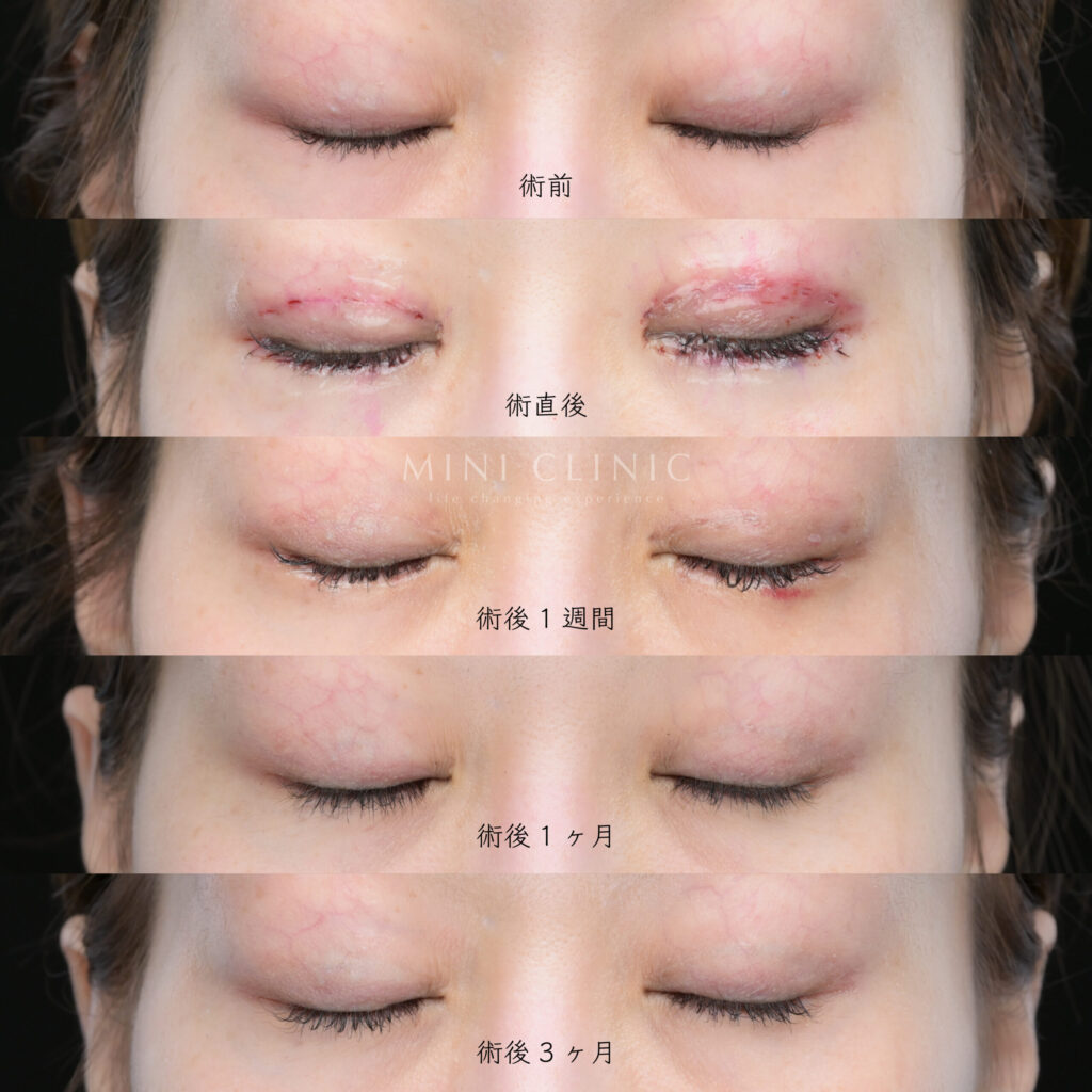 タレ目形成のダウンタイム閉眼