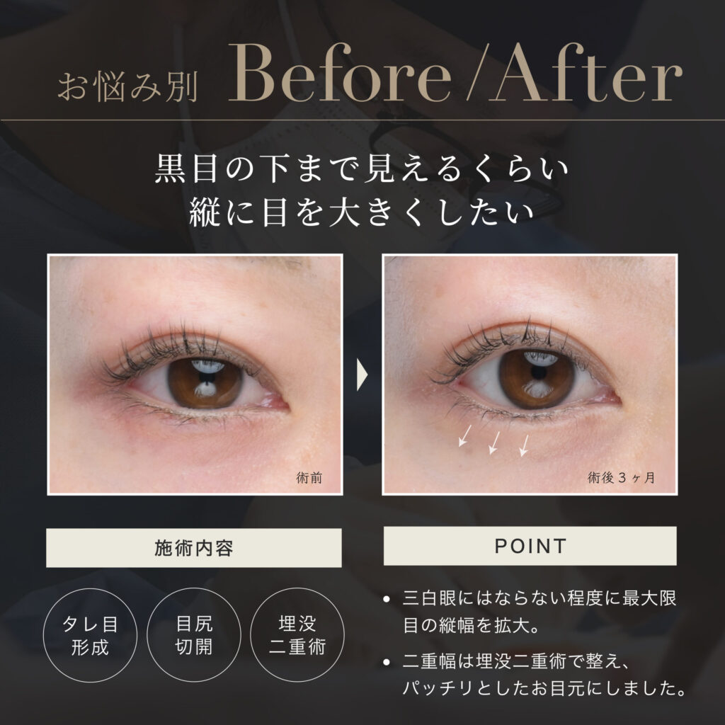 タレ目形成のビフォーアフター