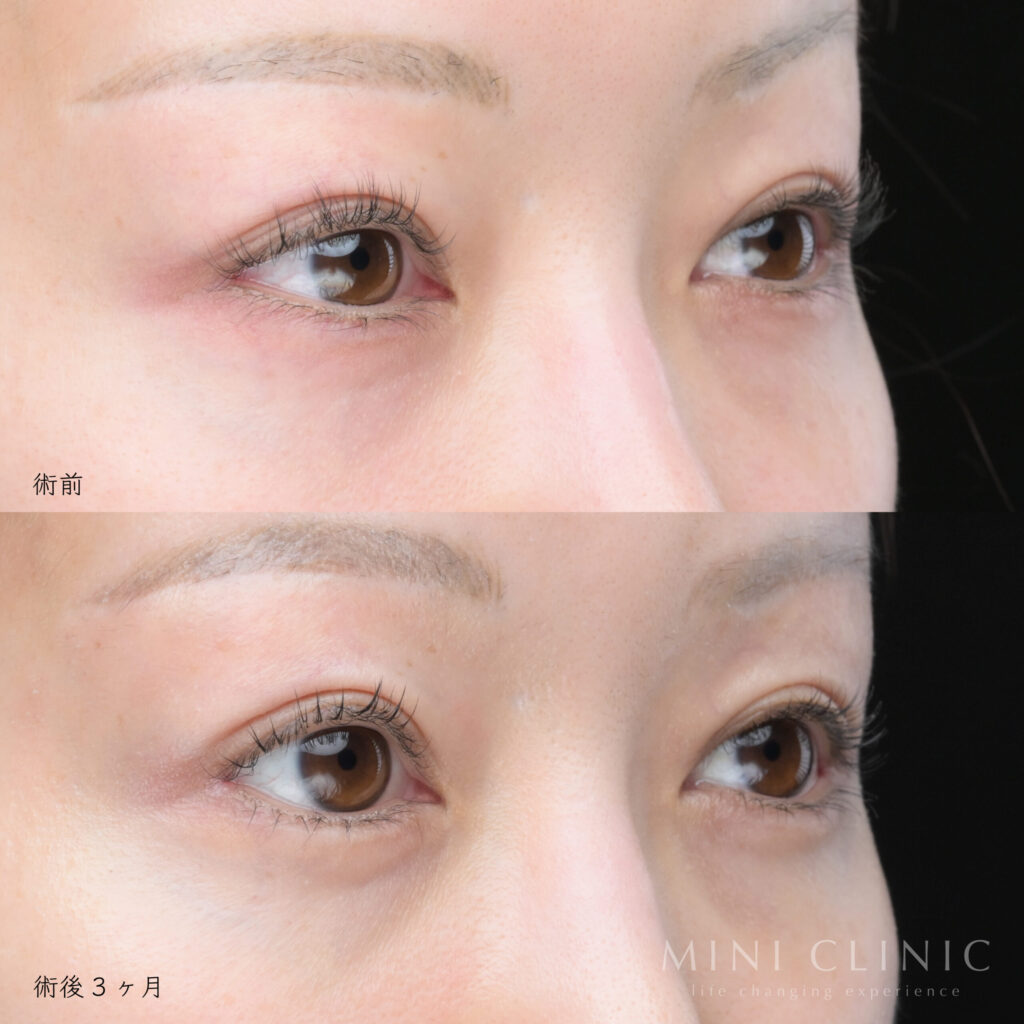 タレ目形成術後斜めの写真