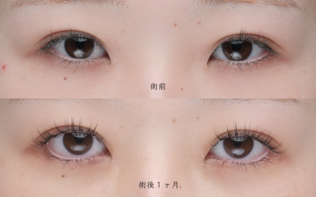 タレ目形成のビフォーアフター