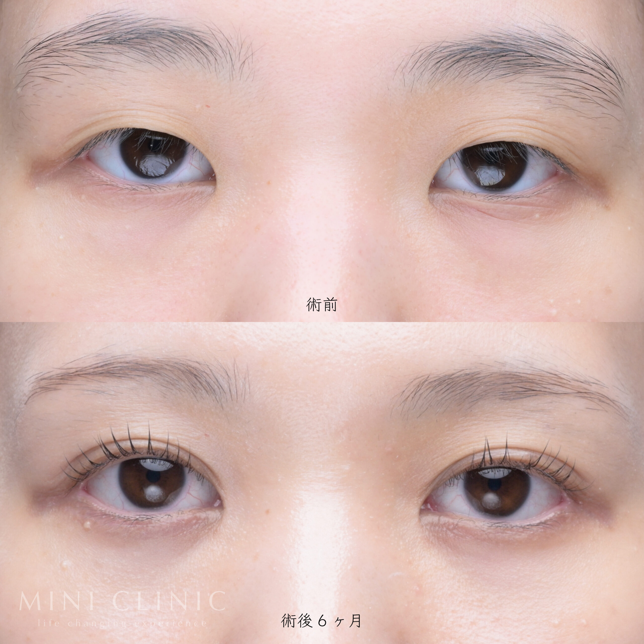 埋没二重術（自然癒着法）
タレ目形成（グラマラスライン形成）
目尻切開
目頭切開（筋弁法）
クマ取り脱脂