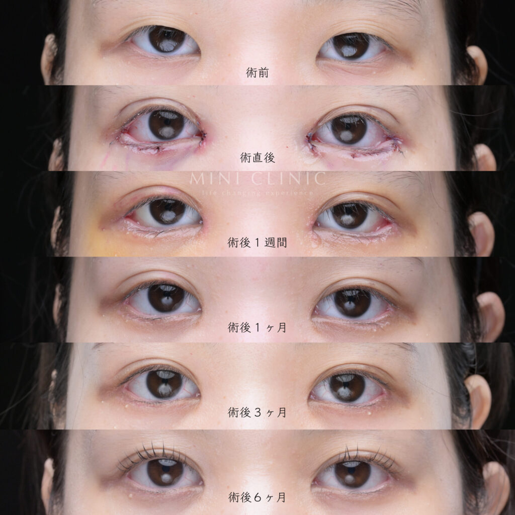ダウンタイムと経過写真