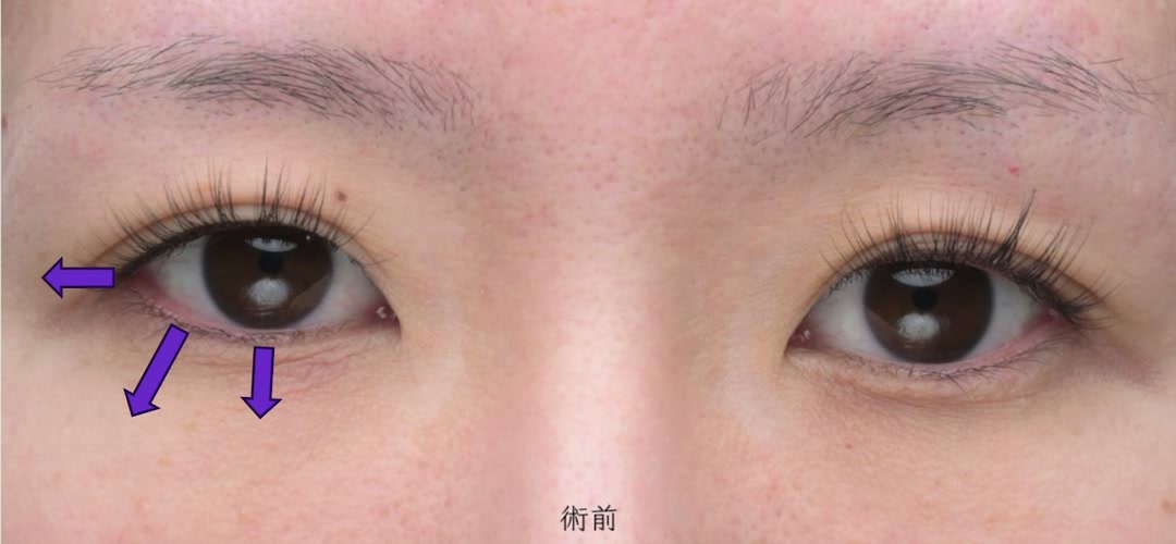 タレ目形成・目尻切開のアセスメント 目尻切開2mmと、タレ目形成で下げる方向(術前)
