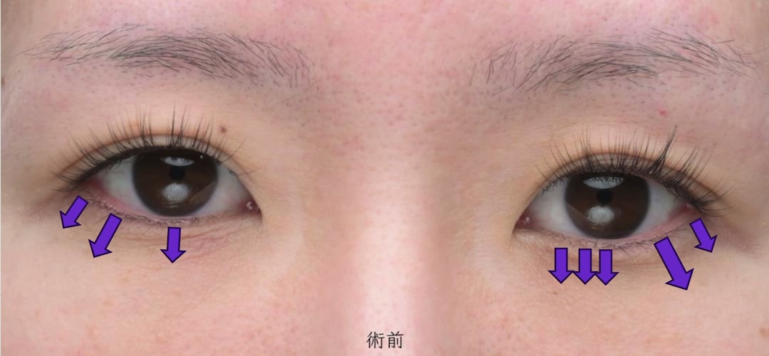 タレ目形成・目尻切開のデザイン 固定位置と下がりのピーク、皮膚切除の量(術前)